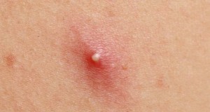 A pimple